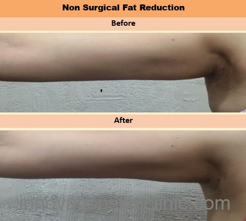 Fat Reduction 4